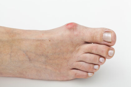 epitact hallux valgus oignon orthèse corrective 2 Alexandre Hryb - etiopathe Cogolin - Saint Tropez - Sainte Maxime - Le Lavandou - La Londe.jpg