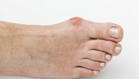 epitact hallux valgus oignon orthèse corrective 2 Alexandre Hryb – etiopathe Cogolin – Saint Tropez – Sainte Maxime – Le Lavandou – La Londe.jpg epitact hallux valgus oignon orthèse corrective 2 Alexandre Hryb - etiopathe Cogolin - Saint Tropez - Sainte Maxime - Le Lavandou - La Londe.jpg