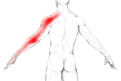 Névralgie cervico-brachiale, douleur bras, douleur cervicale