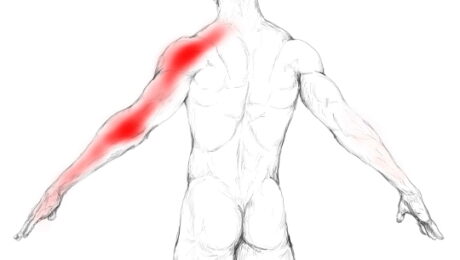 IMG_1530 Névralgie cervico-brachiale, douleur bras, douleur cervicale